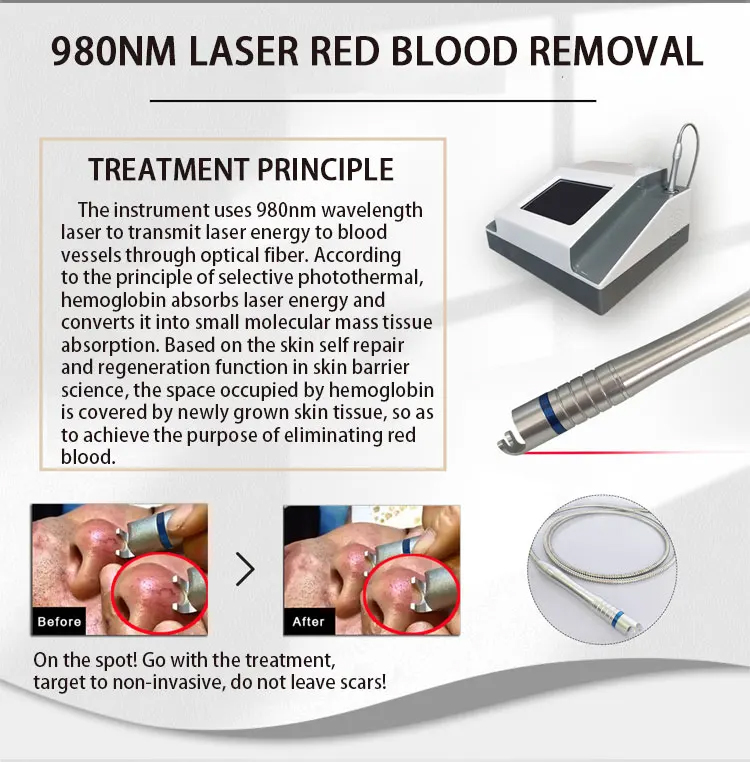 2024 High Tech Diode Laser 980nm for Skin Red Blood Silk Filament Removal Vascular Varicose Treatment Pain-free Beauty Instrument