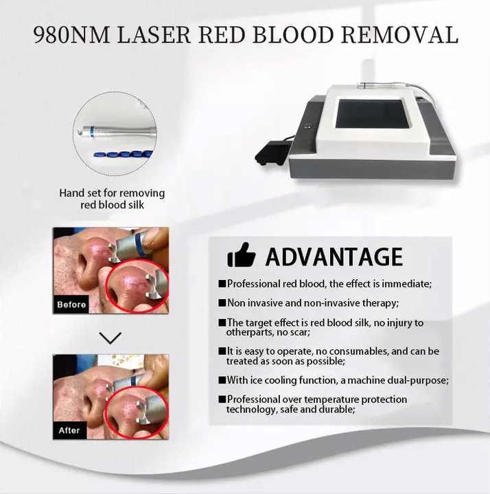 Machine portative efficace de traitement de varices capillaire de retrait de veine d'araignée de soie de sang rouge sûre machine portative de rajeunissement de laser de diode de 980nm