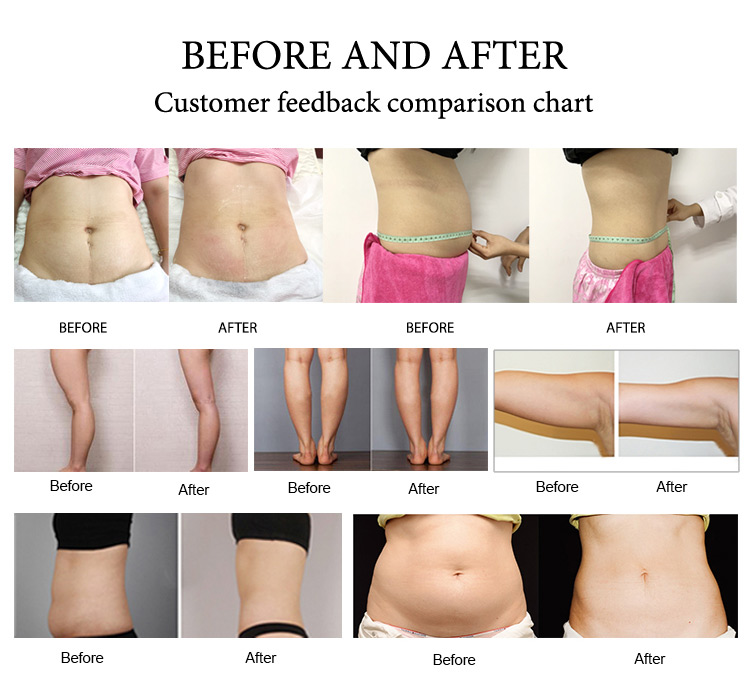 Mage Fat Reduction 40k Cavitation 150 MW Lipolaser Body Slimming Vakuum RF Face Lyftmaskin