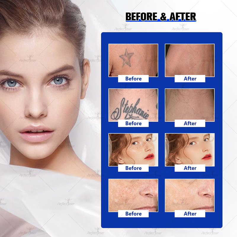 PerfectLaser Pico Laser Tattoo Removal Nd Yag Laser Machine 1064 532 755 1320 4 Golflengten Skin Trachering Pigment Pigment Blackhead Reductie Device Professional