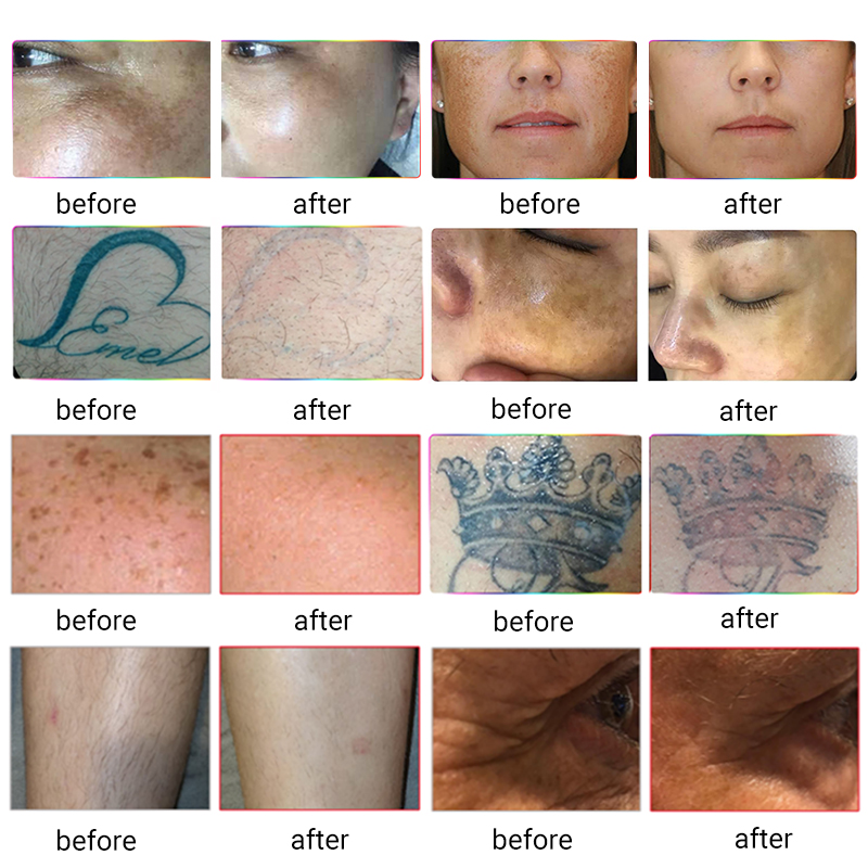 6 em 1 opt SHR Diodo Laser Cabelo Q Interruptor ND YAG Máquina de remoção de tatuagem a laser IPL Skin Skining Salon Beauty Equipment
