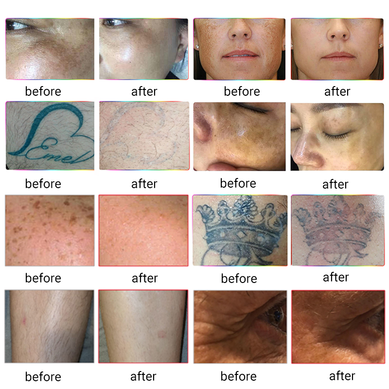 Ultima macchina la depilazione capelli laser IPL RF Elight Skin Stringer Nd YAG Laser Tattoo Rimuovi l'attrezzatura di bellezza