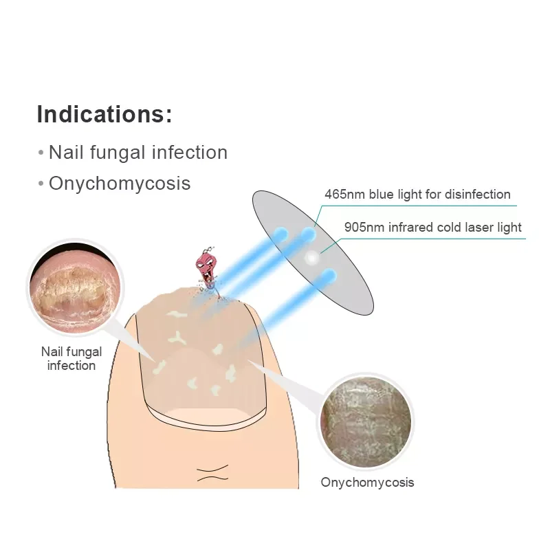 Accessoires FingerNails ToNails Toe nagelschimmel Koude lasertherapie Schimmelinfectie Draadloze behandeling Nagelpaddeigere apparaat