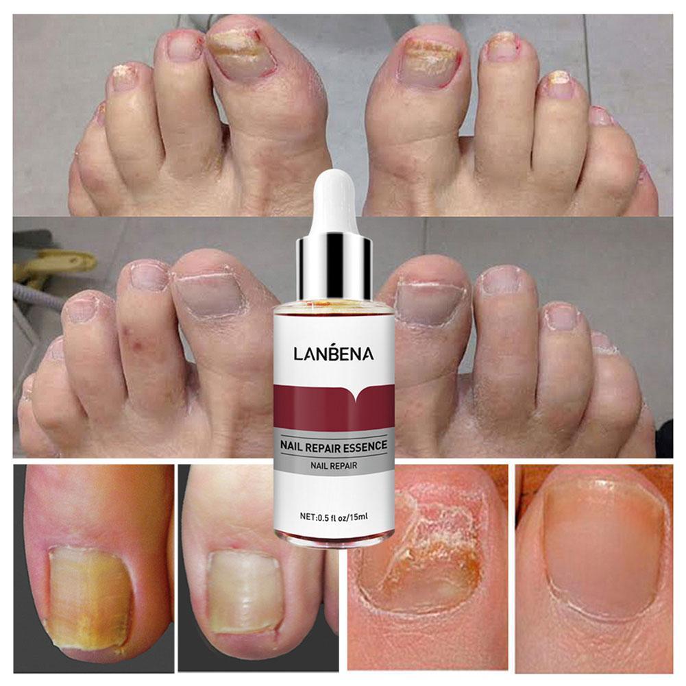 Lanbena Nail Réparation Essence Sérum Traitement des ongles Pied Nail Fongus Retrait Gel Antionychia Onychomycose