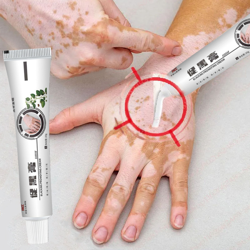 Vitiligo Repair Ointment Herbal Removal Ringworm White Spot Cream Eliminate Get Rid Of Skin Vitiligo Health Skin Care Products