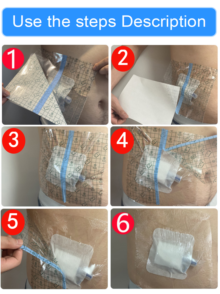 Peritoneal Dialysis Waterproof Transparent Tape Medical PU Film Abdomen Bath Bag Patients Special Care Disposable Protective