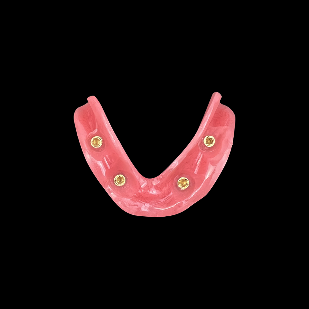 Mascella superiore/inferiore con 4 impianti dentali mandibolari mascellari modello mascellare demo overdenture typodont insegnante di ricerca clinica
