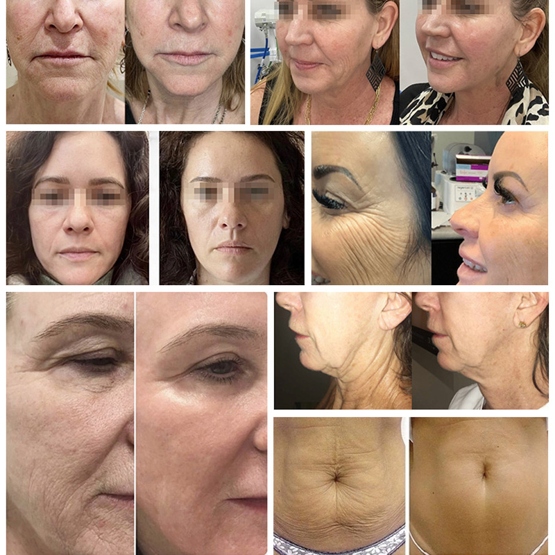 Radio frequency face lift machines rf microneedle fractional acne scars removal micro needling anti age salon machine 2 handle