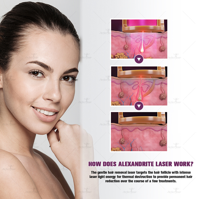 Professionele Alexandrite Long Pulse Alex Laser Hair Removal Machine met Ice Laser Titanium Epilator 1064 ND YAG Laser Epilatie Gezicht Verjonging Schoonheidsapparaat