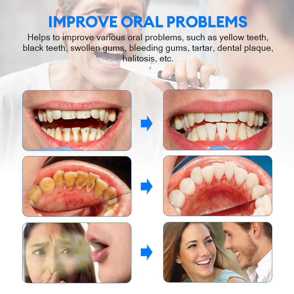 Irrigatori orali Altro Ablatore dentale ad ultrasuoni l'igiene dei denti Macchie di tartaro Rimozione del calcolo dei denti Detergente placca sonico elettrico Pietra 221215