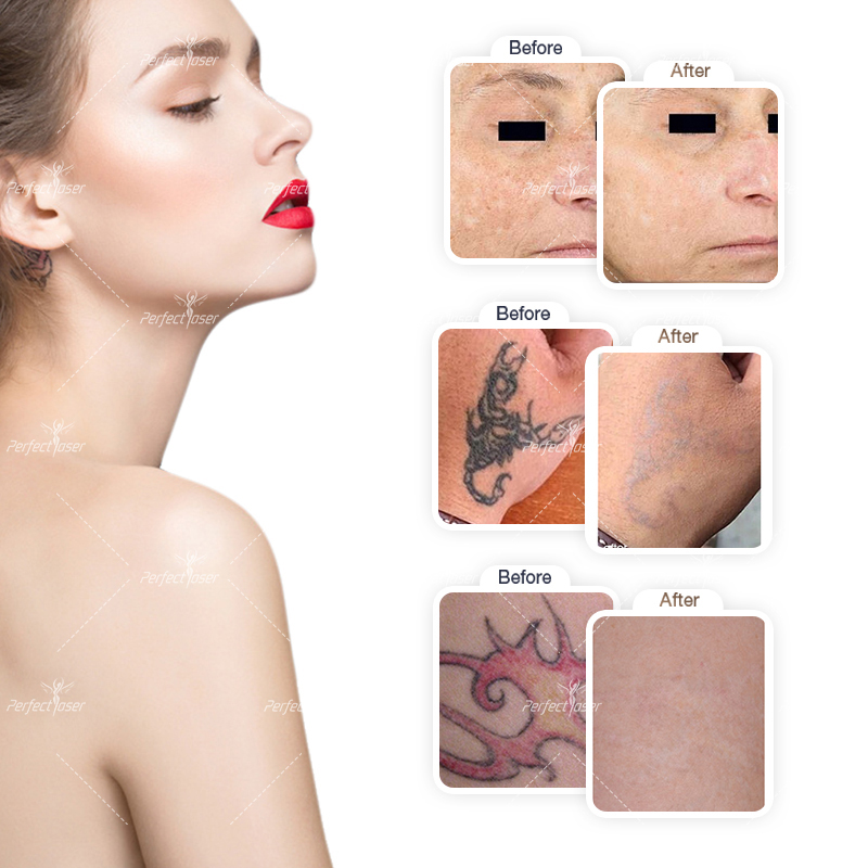 Professionell tatto borttagning Lasermaskin picosekund pico laserpigmentering Acne ärrbehandlingsutrustning 532nm 755nm 1320nm 1064nm