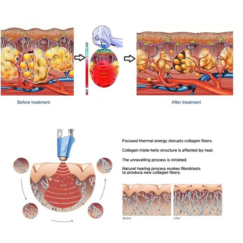 Novo 2 IN1 Removedor de rugas para levantamento de face e pescoço ultrassônicas, remoção de celulite da máquina de emagrecimento, queima de gordura queima de gordura não invasiva Moldura do corpo com formação