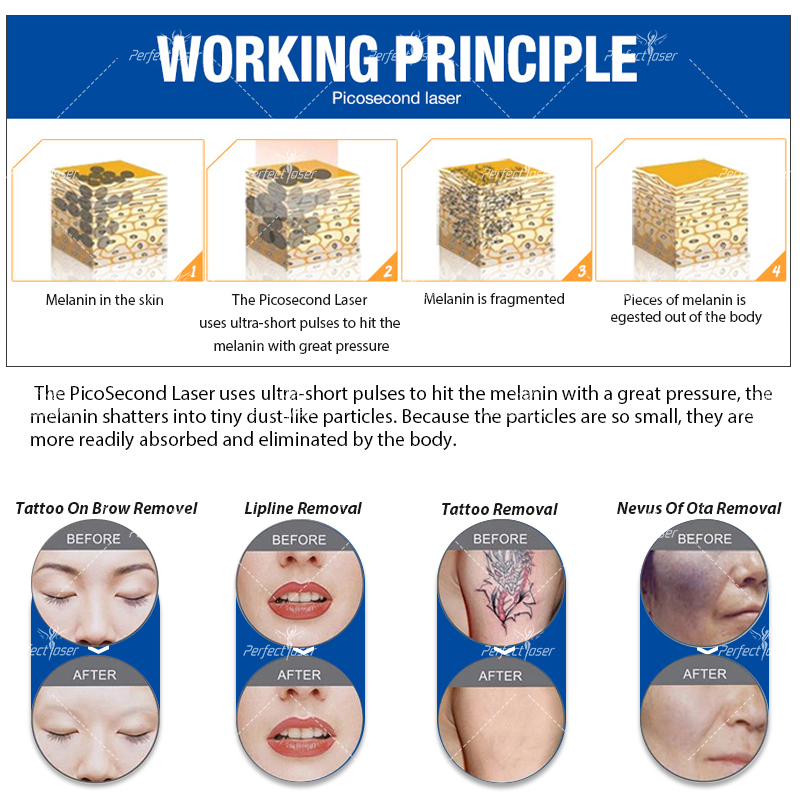 전문 4 파장 레이저 눈썹 세척 Q 스위치 피코 초 레이저 문신 제거 피코 피부 회춘 머신