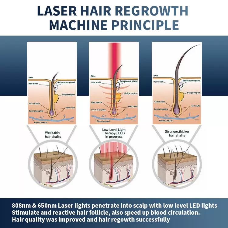 1200W Haarlüftungsmaschine Dioden Laser Haarentfernungsmaschine Laser Haarwachstum Maschine