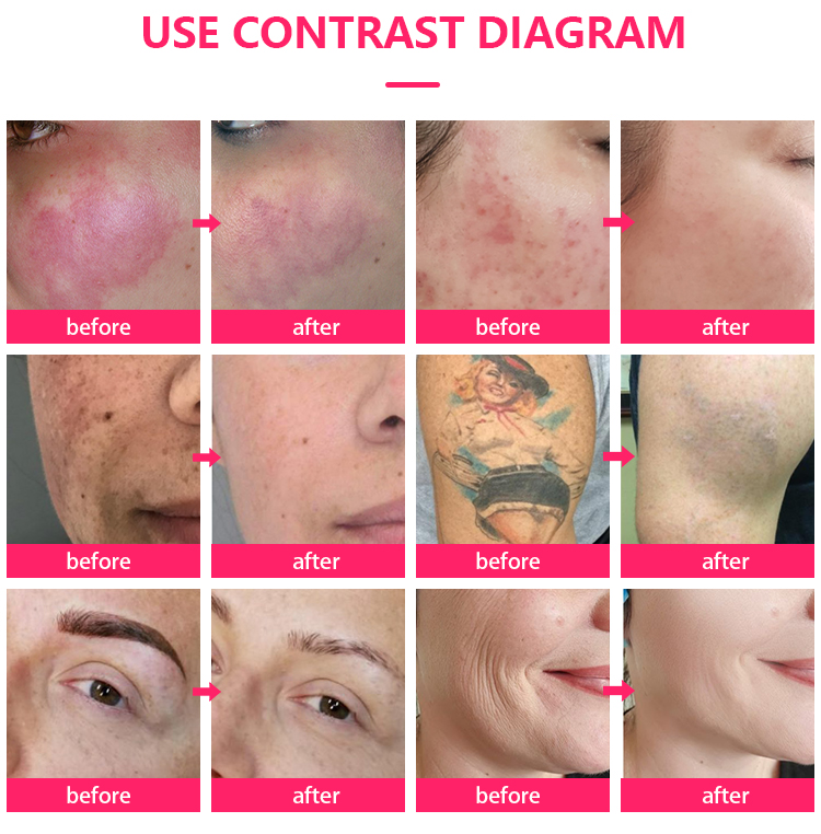 itens de beleza laser picossegundos 1064nm 532nm Remoção de tatuagem de marca de nascença nd yag espectros tonificando tonificação de melasma de melanas de carbono facial de carbono