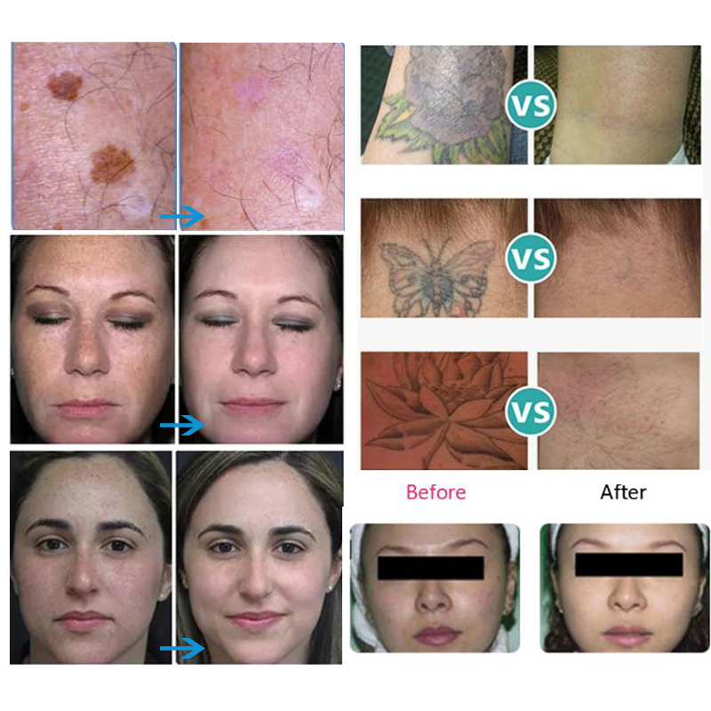 Nd yag laser détatouage portable q switch rajeunissement de la peau lazer pigmentation traitement équipement de beauté multifonctionnel