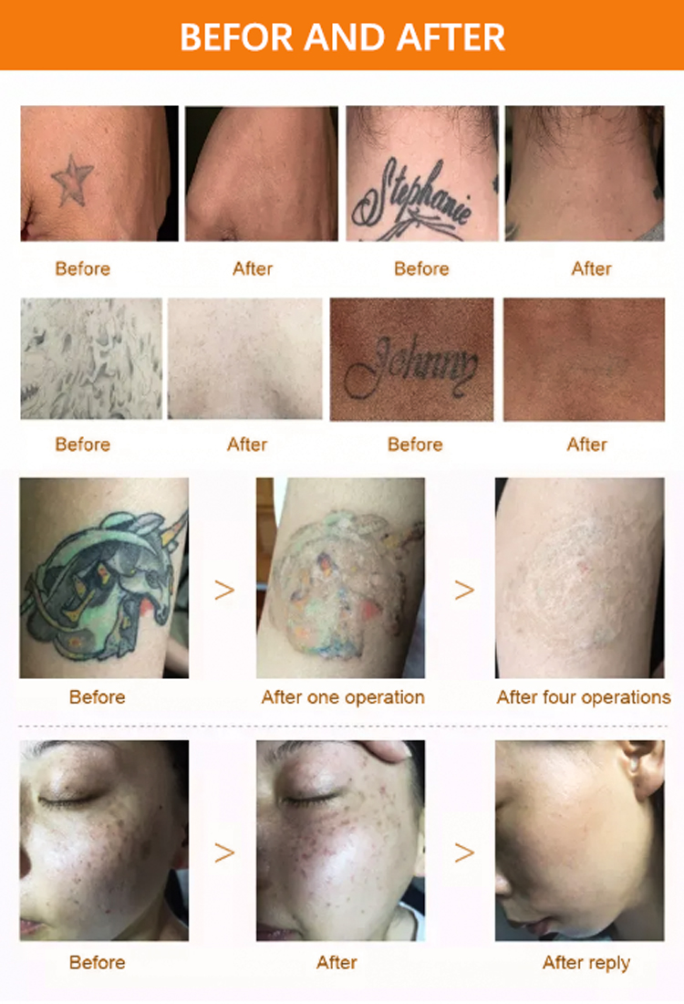 Remoção de tatuagem Pico Machine Machine China Remoção Tatuagem q Máquina de tratamento com acne de acne com troca de YAG