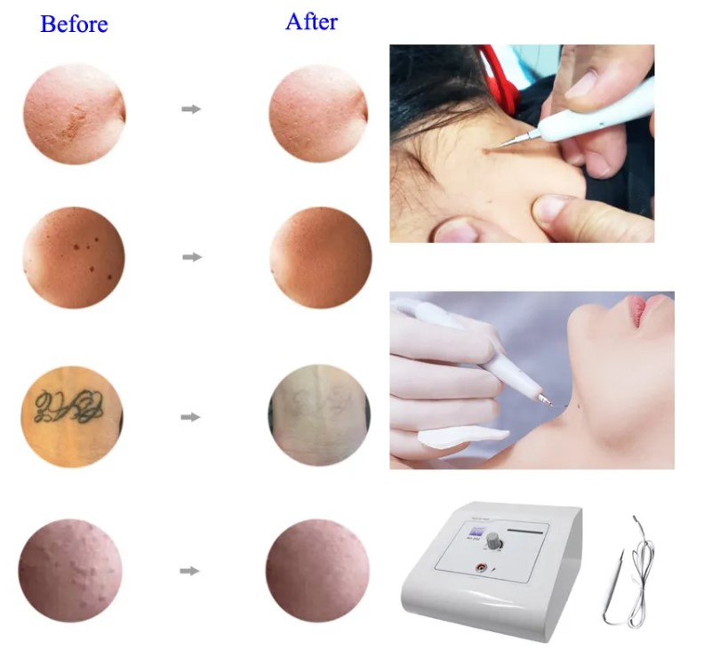 Cautery Machine Removal Of Mole Skintags Warts Professional Electrical Cautery Wart Removal Machine For Salon