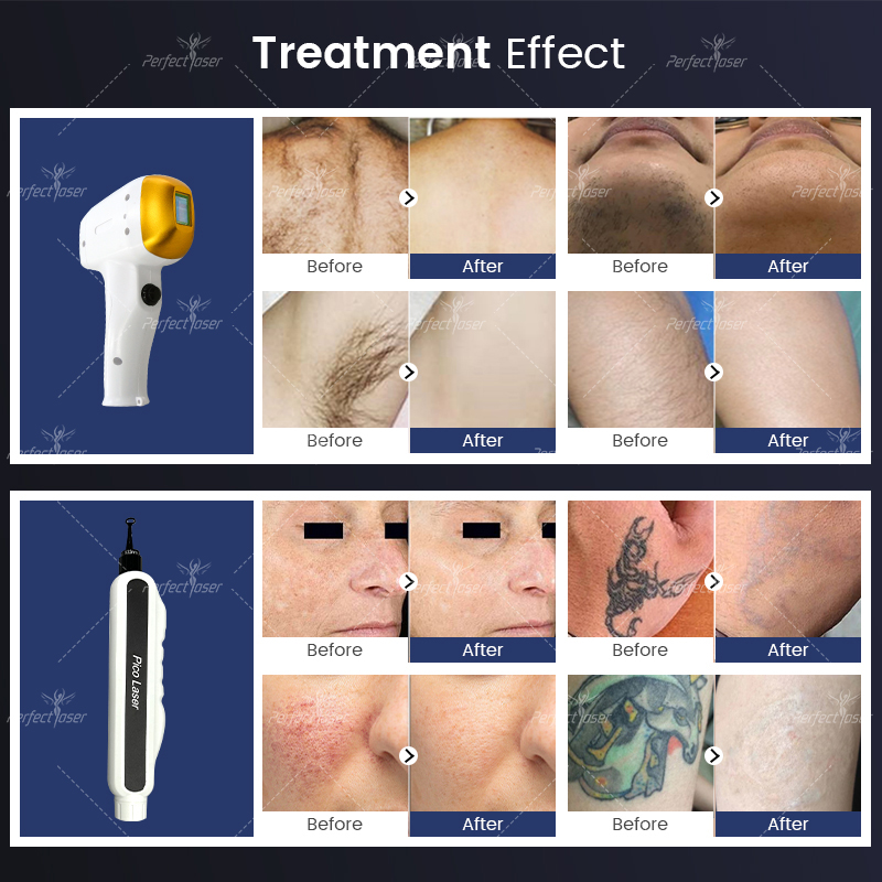 PerfectLaser 2024 Najnowsze usuwanie włosów 808nm Diode laser stały pico tatuaż Usuń maszynę picosekundowe odmłodzenie skóry 808 depilacja