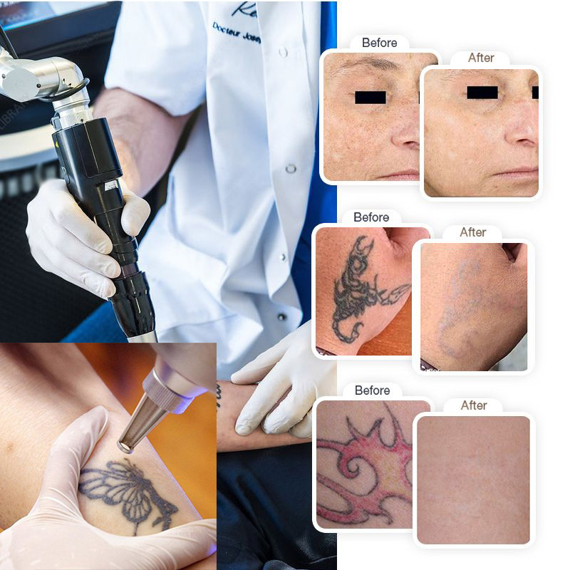 2023 Scoperta professionale Laser Acne Spot pigmentazione Trattamento 532nm 1064nm 755nm Carbon Lazer nevo di rimozione Ota