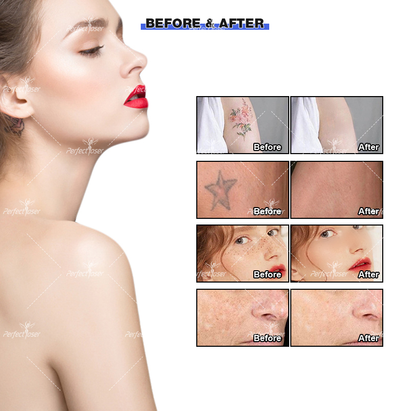 Machine de retrait de tatouage foncé, Laser picoseconde, élimine les ridules du visage, Pico deuxième pigmentation, équipement de rajeunissement de la peau