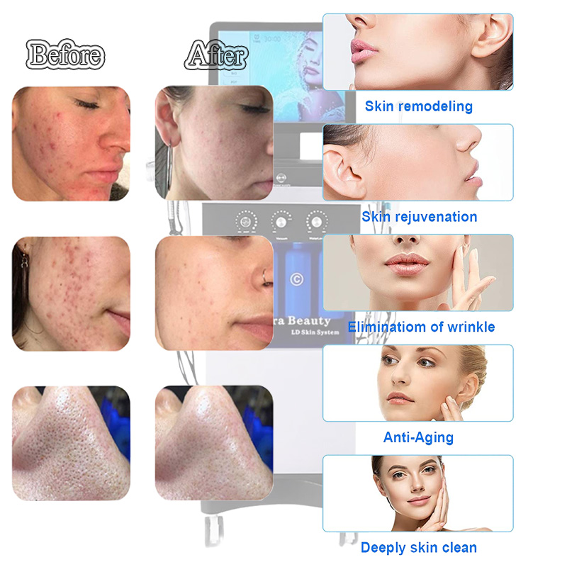 Nova chegada 14 em 1 hidrelm de microdermobrasão facial hidrelmal aqua peeling hidra ultrassom h2o2 microcorrente facial bio dispositivo