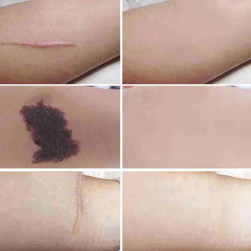 Temporära tatueringar Nya 6st Tattoo Cover Up Skin Color Scal Concealer Klistermärke Portable Flaw Birth Mark Dolda vattentäta skönhet Kosmetiska verktyg Z0403