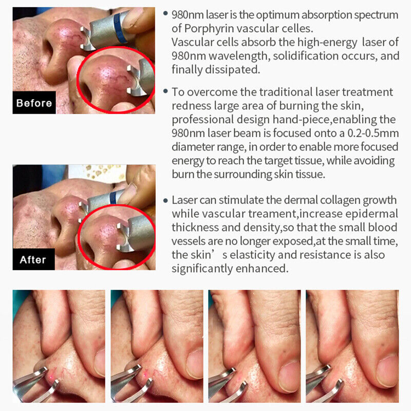 4 en 1 980nm Diode Laser Vascular Spider Vein Removal Traitement de l'acné Rajeunissement de la peau Physiothérapie Soulagement de la douleur Laser Beauty Machine