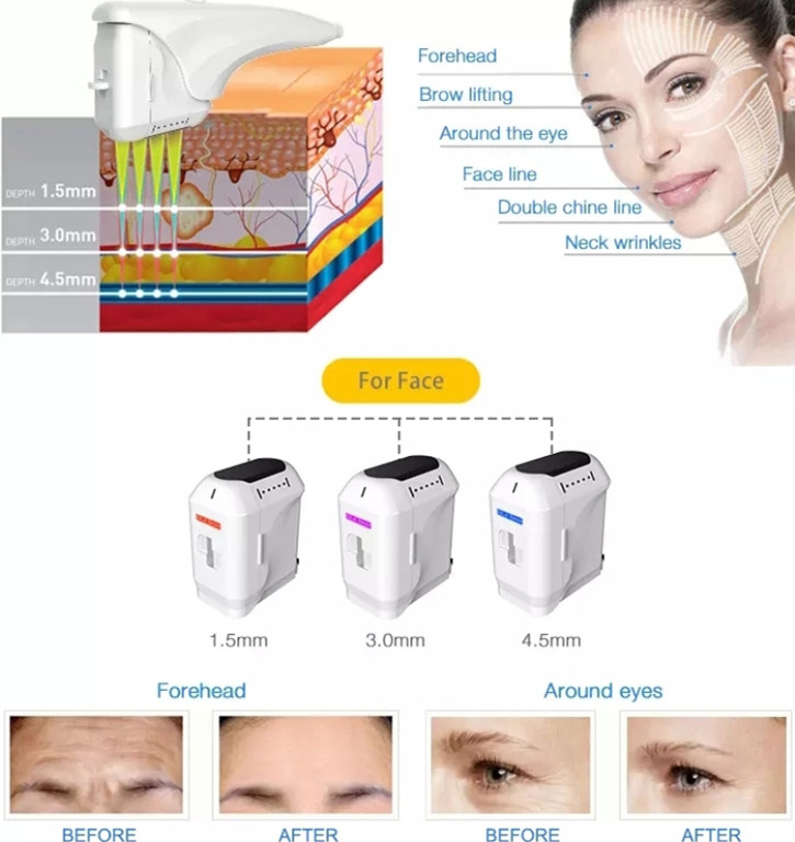 2023 Top Sales 2 EM 1 4D HIFU RF Machine 7D HIFU liposonix Smas Anti Wrinkle Face Lifting Machine / liposonix Machine