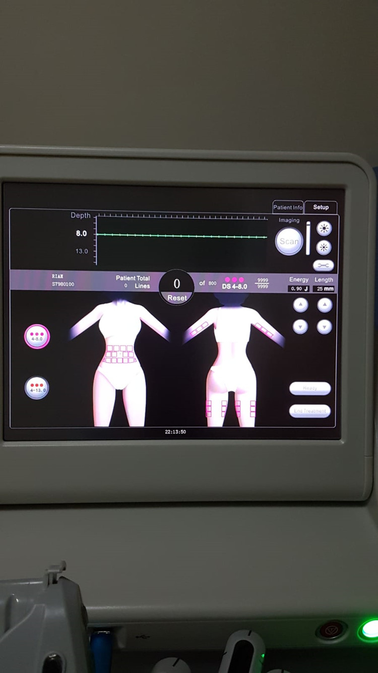 Ultrasound Hifu Beauty Items Face Lifting Smas para remoção de rugas Corporaly Facial Anti-rugas Firming Machine