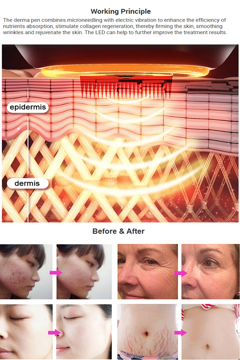 beleza doméstica 7 cores LED Light fototerapia dermapen Electric Microneedle para estrias de cicatriz anti acne com Derma caneta carregador em mais rápido Skinpen Skinpen