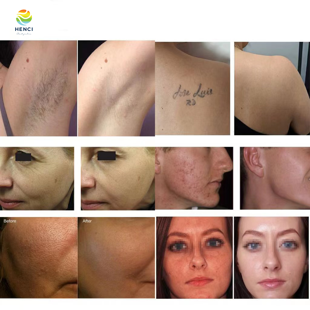 RF Technology For Skin Rejuvenation Freckles Treatment Laser Machine Tattoo Removal Device Nd yag Ipl Laser Hair Remove Suitable All Type Of Skins