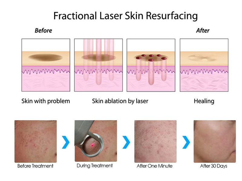 Resurfaçage au laser CO2 portable pour la beauté de la peau - Élimination fractionnelle des grains de beauté Pico au prix de Hong Kong