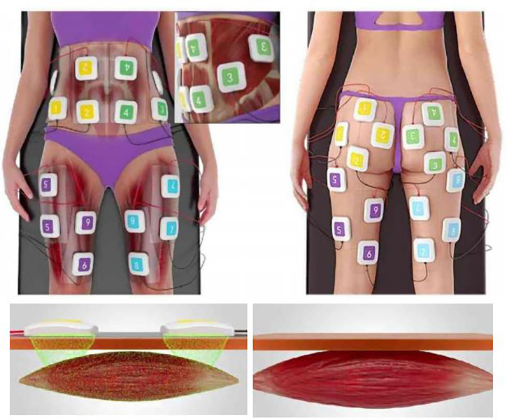 Profesyonel EMS kas oluşturma güzellik cihazı terapi ekipmanı vücut zayıflama şekillendirme selülit azaltma
