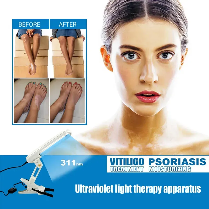 Maske UVB 311NM Vitiligo Psoriasis Egzama Dermatit için Işık Terapisi Cilt Sorunları Tedavisi UV lambası 110V/220V