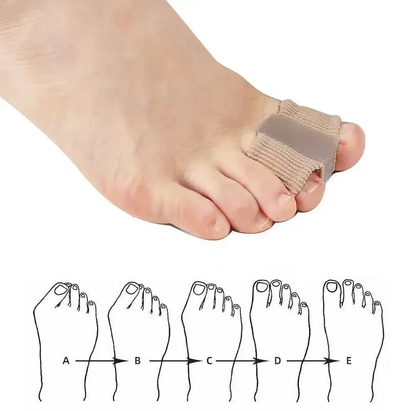 Toe Spacers for Women Men Bunion Corrector, Toe Separators for Bunion Correction, Hammer Toe Straightener Toe Spreaders for Overlapping, Hallux Valgus