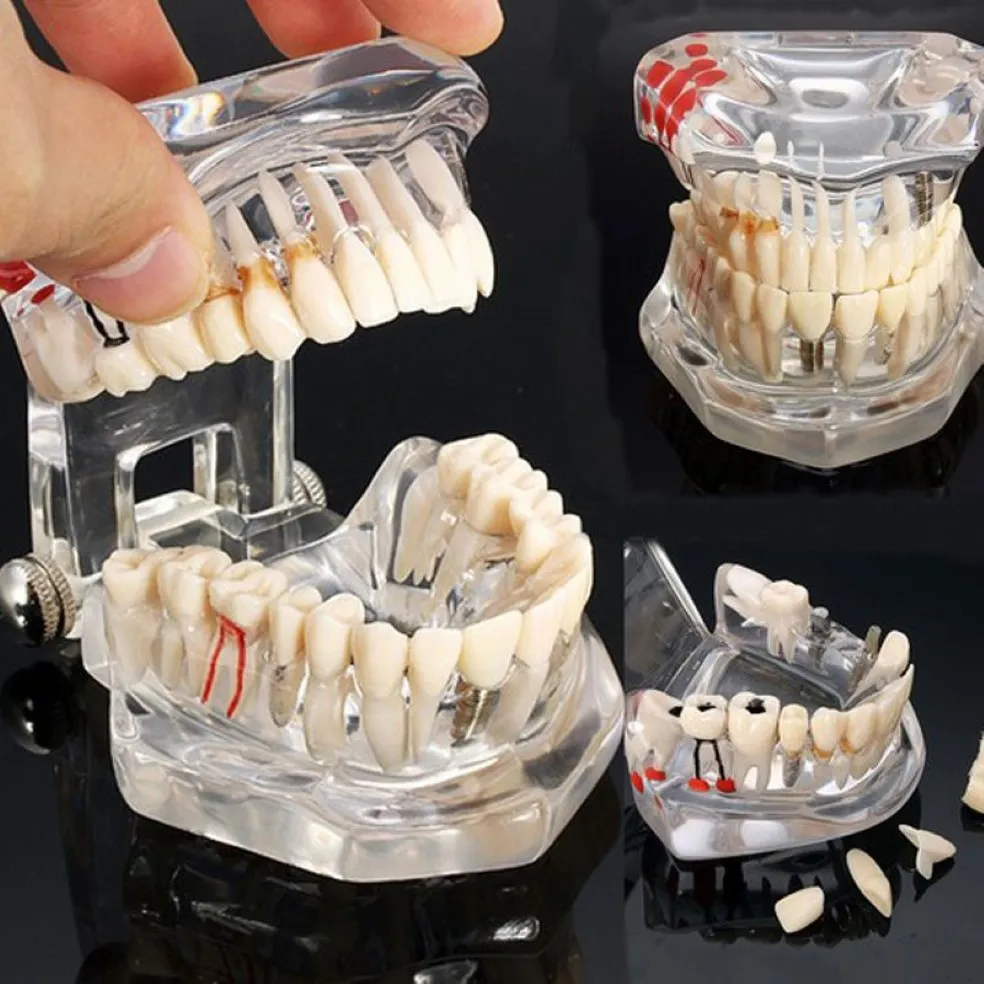 Dental Implant Disease Teeth Model With Restoration Bridge Tooth Dentist For Medical Science Dental Disease Teaching Study206A