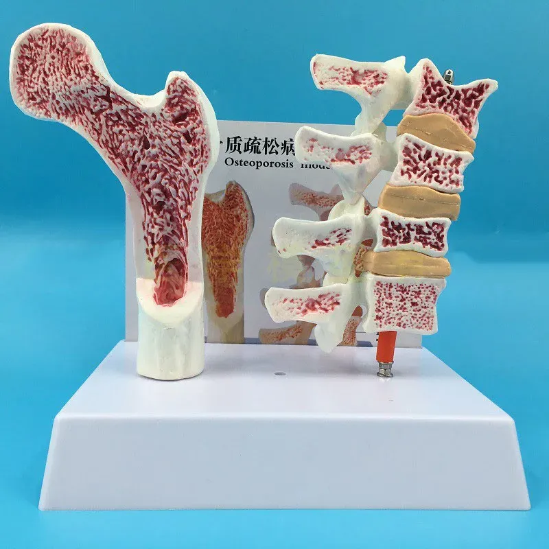 Miniaturen 2 Teile PVC Humanes anatomisches Modell Osteoporose Femur Beinknochen Wirbelsäulenabschnitt Probe erkrankte Lendenwirbelsäule