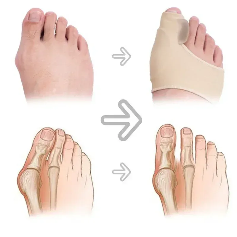 = dedo dedo do pé de dedo do pé alux valgus bunion corretor ortons pés pés ósseo polegar correção de correção de pedicure alisador de meia