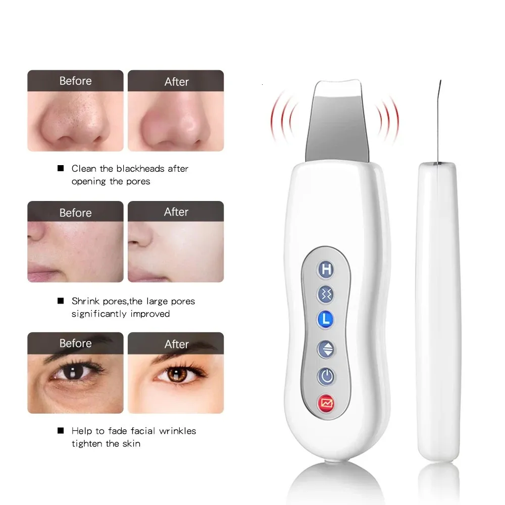 Ultrasonic Ion Skin Scrubber: Vibrating Facial Scraper For Blackhead ...