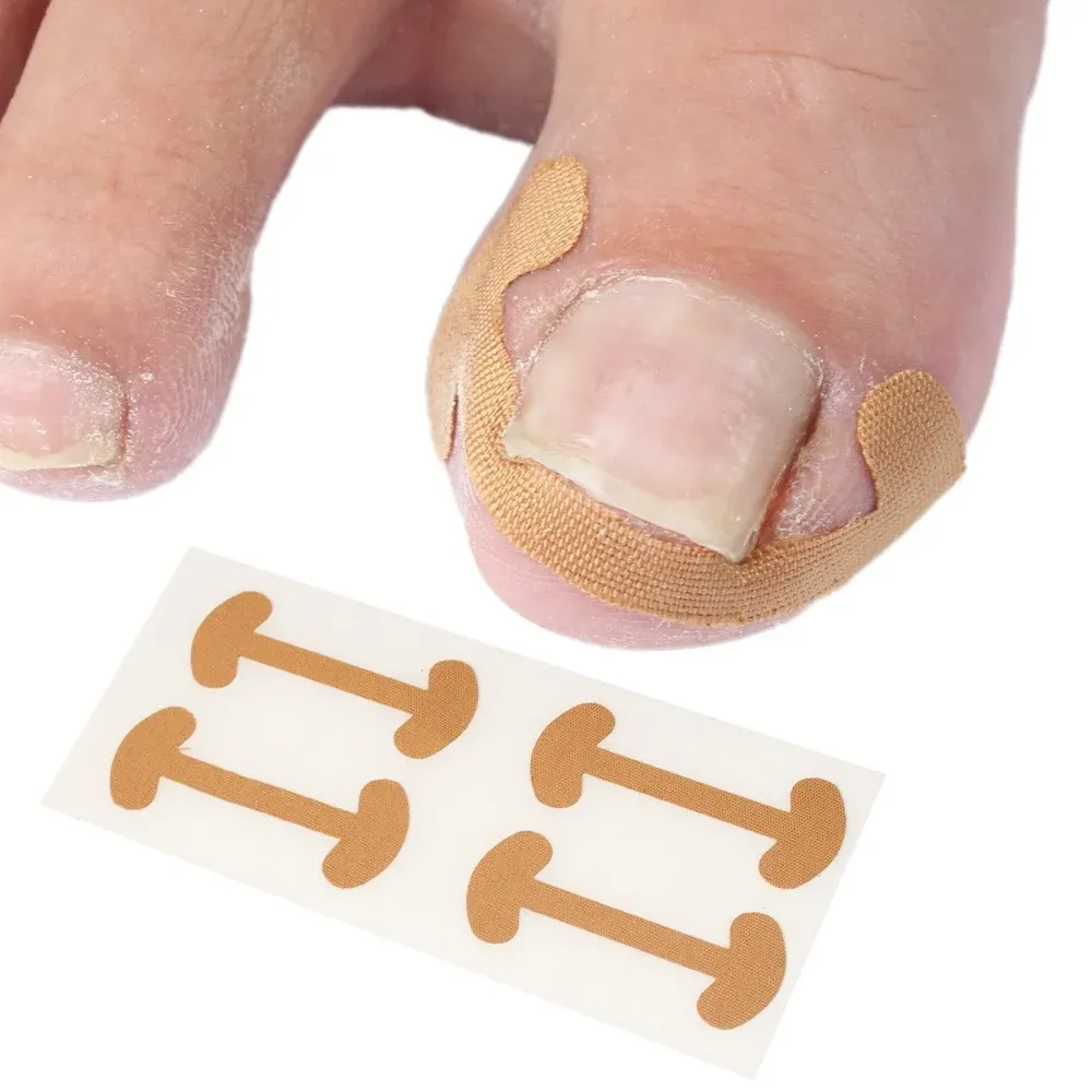 20pcs Professionnel incarné des pieds d'ongle d'ongle autocollants Élasticité Élasticité Toe Nail Care pédicure outils de santé protège les ongles