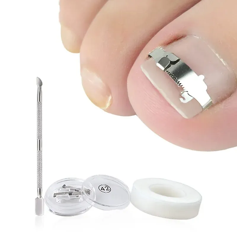 2024 Ingrown Toenail Corrector Orthotic Nail Fixer Toenail Correction Treatment Foot Care Tools Recover Embed Tool Sure, here are