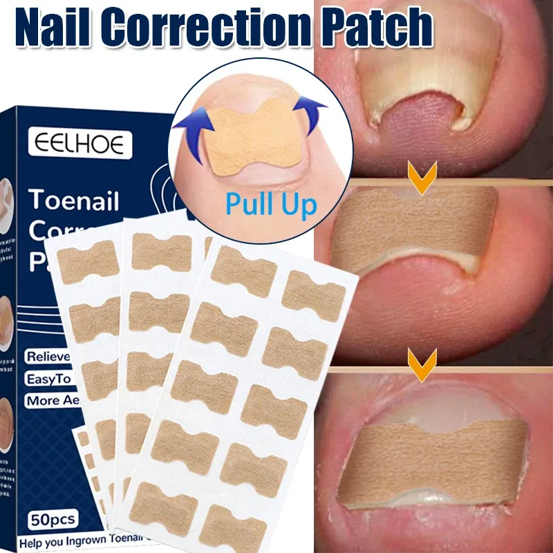 Treatments 50pcs Nail Correction Stickers Ingrown Toenail Paronychia Treatment Corrector Waterproof Elastic Painless Patches Pedicure Tools