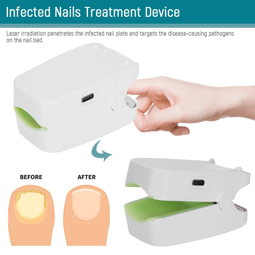 Behandlingar smärtfri nagelsvamp laserterapi enhet mini nagelbehandlingsmaskin nagel borttagande svampinfektion nagel terapeutisk inst 905nm
