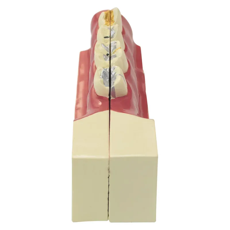 Modèle d'enseignement dentaire Réparation pathologique de la dent impactée Pulp pour l'enseignement et la formation de la dentisterie de dentiste