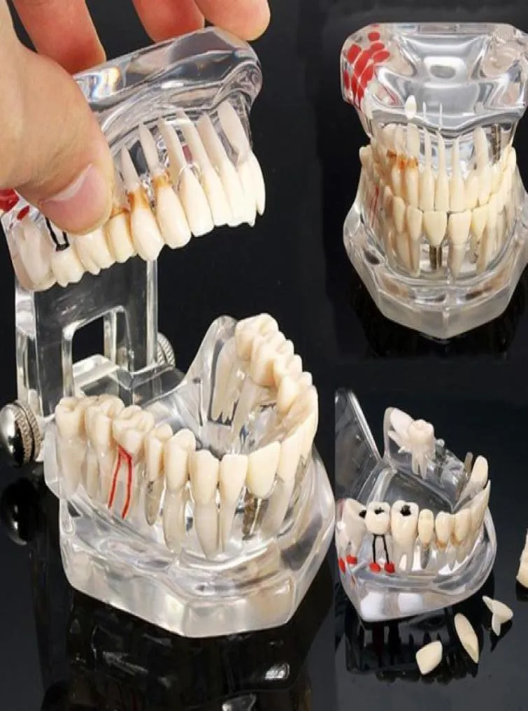 Modello dei denti della malattia dell'impianto dentale di arti e artigianato con dente di denti del ponte di restauro per lo studio di insegnamento scientifico14849824