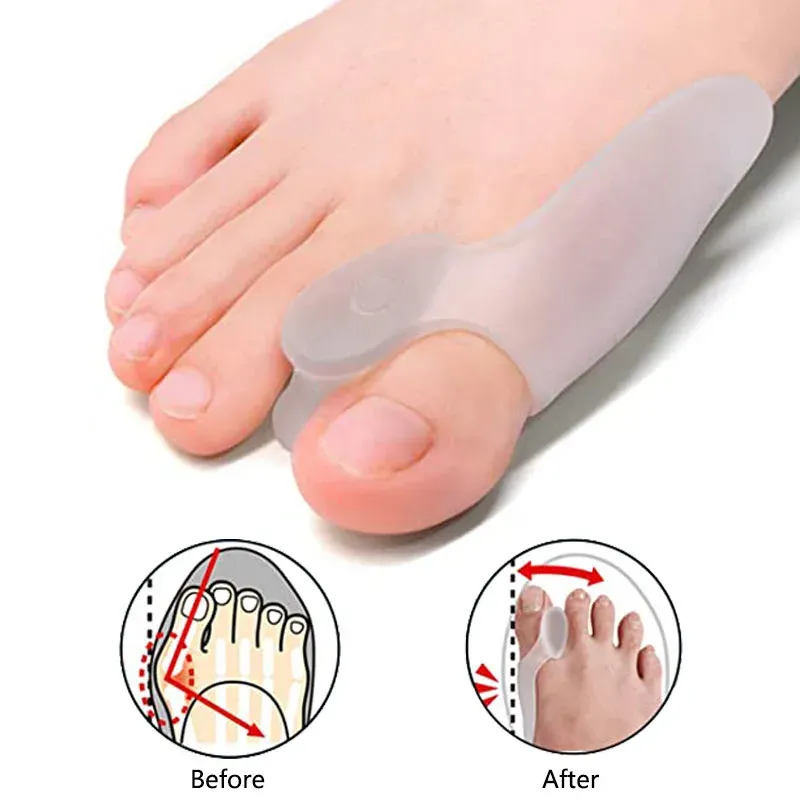 Traitement 2pcs Hallux Valgus Correcteur PAD SILICONE TOE FIGNET Séparateur Soulagez l'outil de soins aux pieds Adjustner à l'orteil