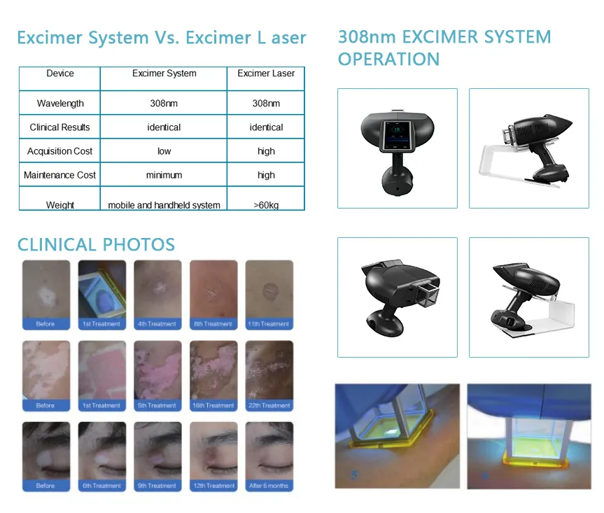 Portable 308nm Excimer Laser Device for Psoriasis Vitiligo Treatment ...