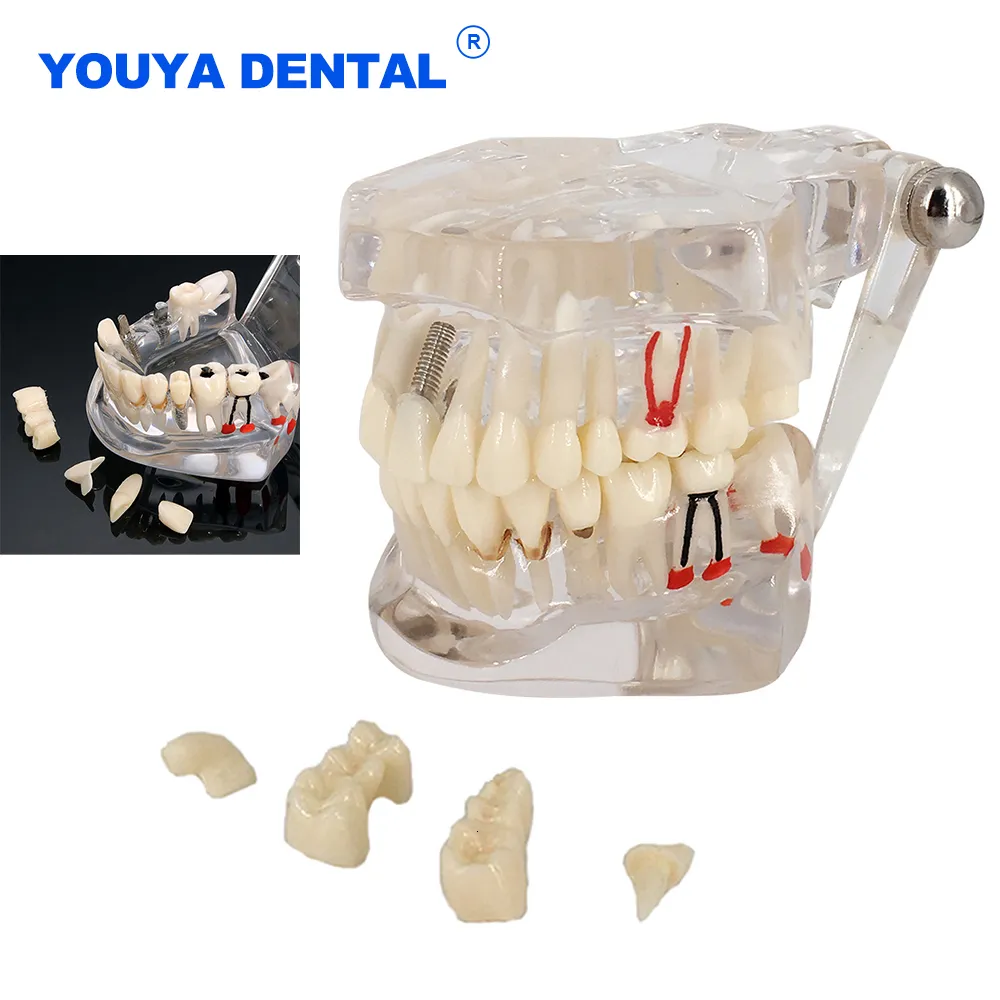 Autre modèle d'implant d'hygiène bucco-dentaire Maladie Dents Réparation neuronale Pathologique Typodont Restauration Pont Enseignement Étude Science 230915