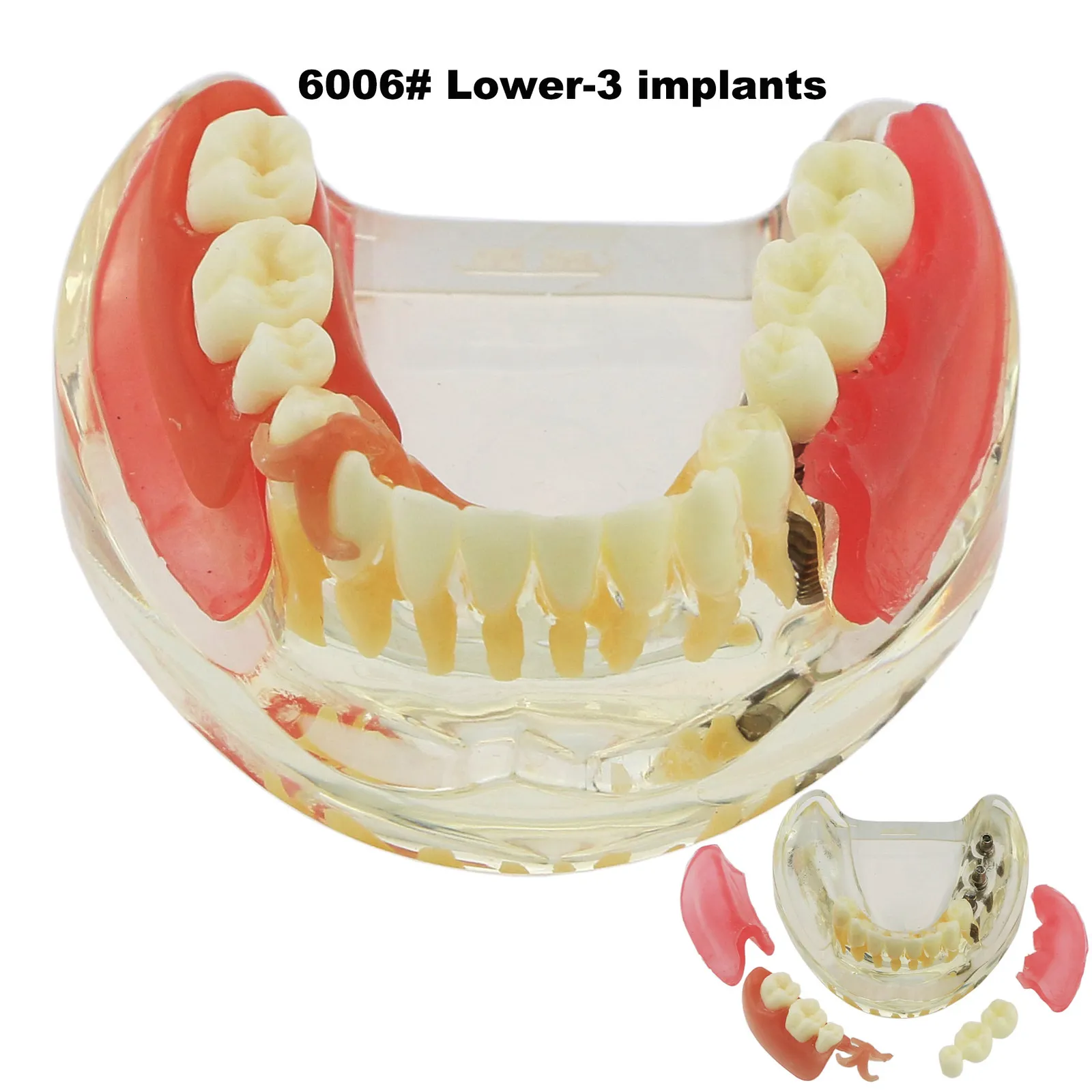 Outros dentes de implante dentário de higiene oral modelo M6006 Typodont Overdenture 3 implantes ponte inferior inferior tratamento de restauração estudo de demonstração ensinar 230915